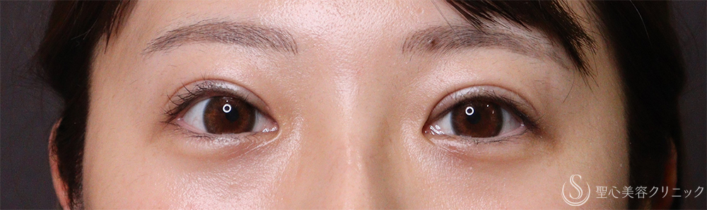 【30代女性・二重】二重切開法（眼窩脂肪除去）（6ヶ月後） After 