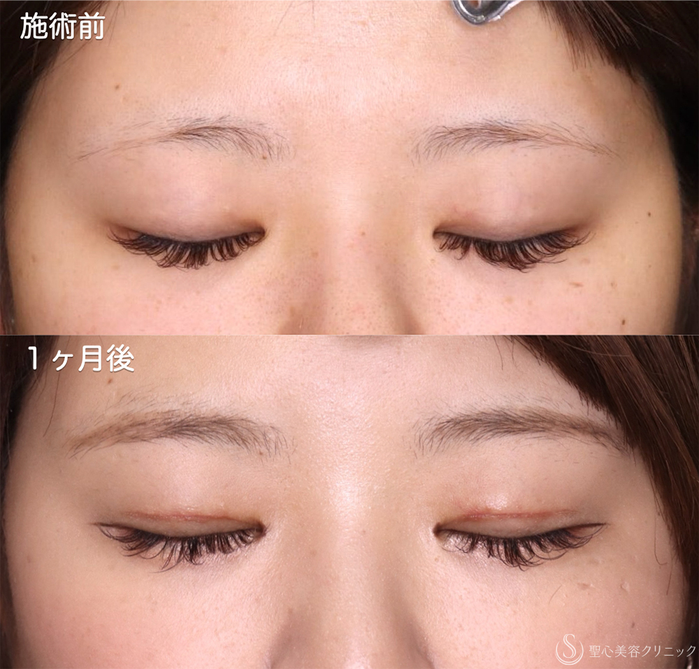 【20代女性・埋没では維持できない目元に、“切開”という確かな選択を- ダウンタイムは最小限に】二重術（切開法）部分切開/全切開＋脱脂（1ヶ月後） After 