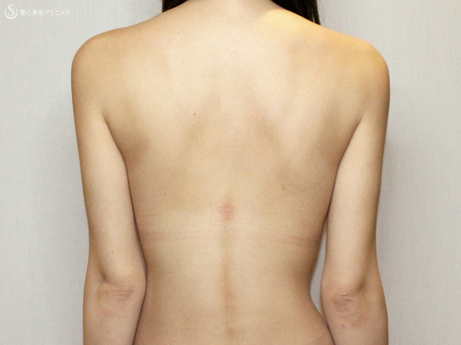 【20代女性・夏の「二の腕」のお悩み解消】ベイザー脂肪吸引（2年後） After 