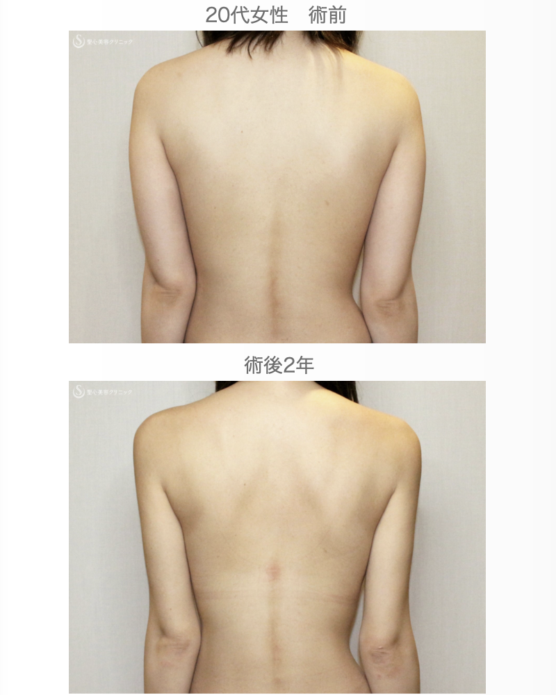 【20代女性・夏の「二の腕」のお悩み解消】ベイザー脂肪吸引（2年後） After 