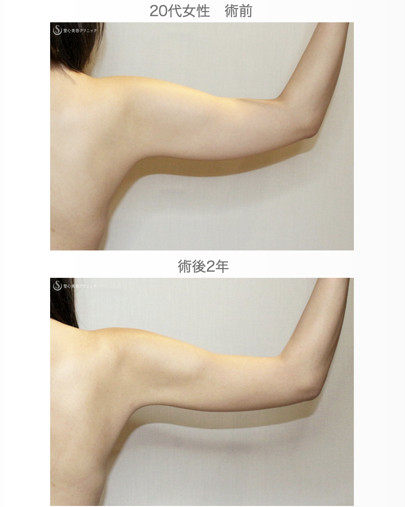 【20代女性・夏の「二の腕」のお悩み解消】ベイザー脂肪吸引（2年後） After 