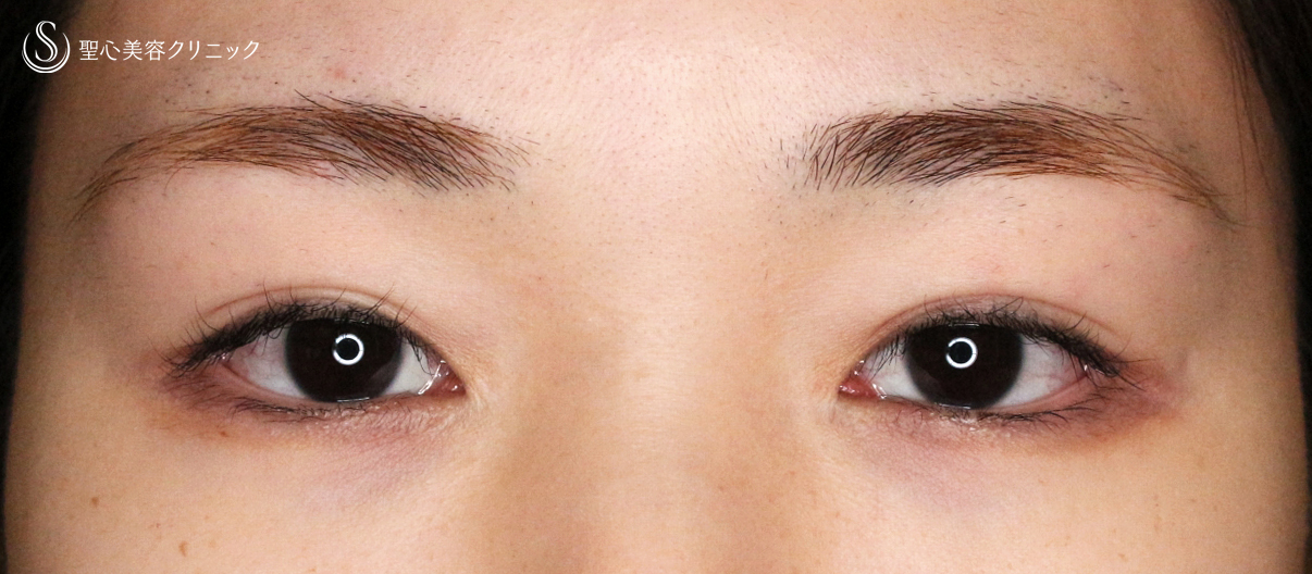 【20代女性・他院埋没法後を全切開で修正】二重全切開+α法 Ver.5.5（直後〜3ヶ月後） Before 