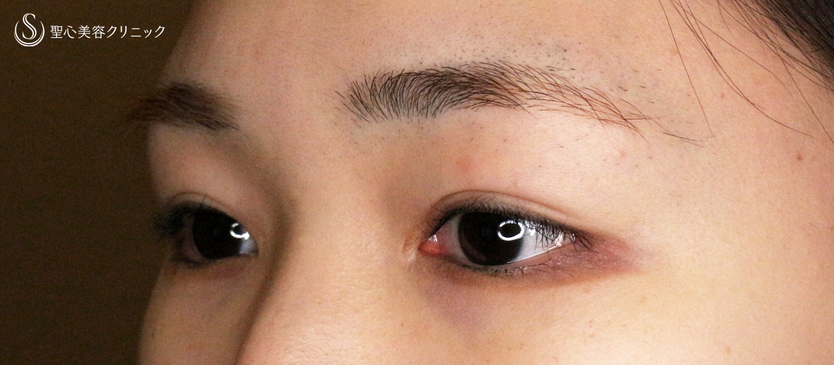 【20代女性・他院埋没法後を全切開で修正】二重全切開+α法 Ver.5.5（直後〜3ヶ月後） Before 