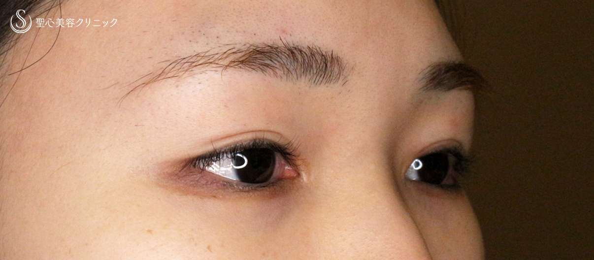 【20代女性・他院埋没法後を全切開で修正】二重全切開+α法 Ver.5.5（直後〜3ヶ月後） Before 