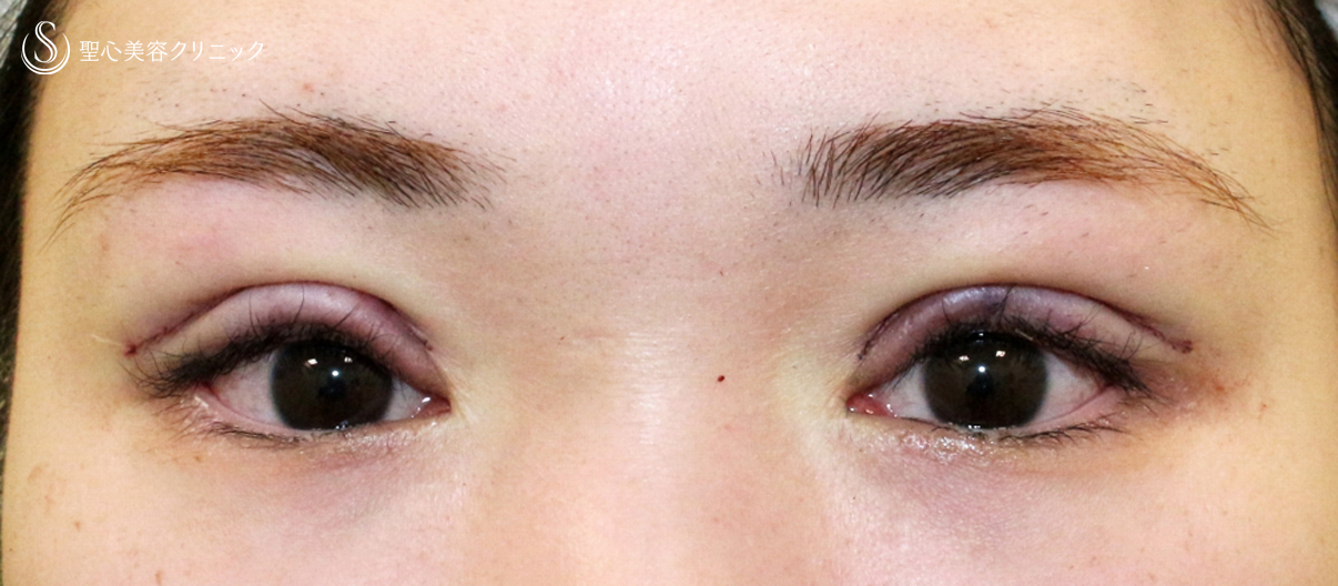 【20代女性・他院埋没法後を全切開で修正】二重全切開+α法 Ver.5.5（直後〜3ヶ月後） Before 