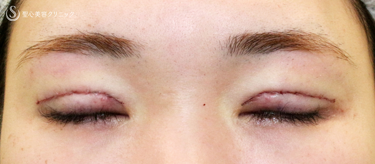 【20代女性・他院埋没法後を全切開で修正】二重全切開+α法 Ver.5.5（直後〜3ヶ月後） Before 