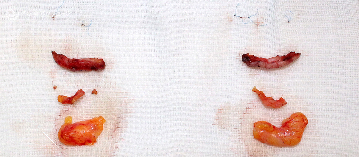 【20代女性・他院埋没法後を全切開で修正】二重全切開+α法 Ver.5.5（直後〜3ヶ月後） Before 