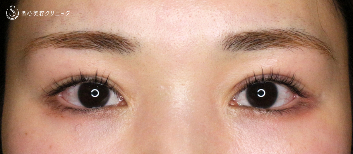 【20代女性・他院埋没法後を全切開で修正】二重全切開+α法 Ver.5.5（直後〜3ヶ月後） After 