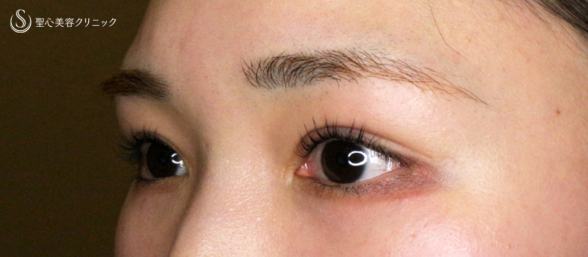 【20代女性・他院埋没法後を全切開で修正】二重全切開+α法 Ver.5.5（直後〜3ヶ月後） After 