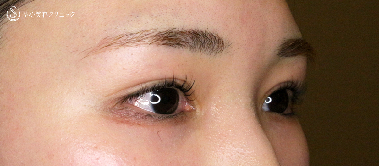 【20代女性・他院埋没法後を全切開で修正】二重全切開+α法 Ver.5.5（直後〜3ヶ月後） After 