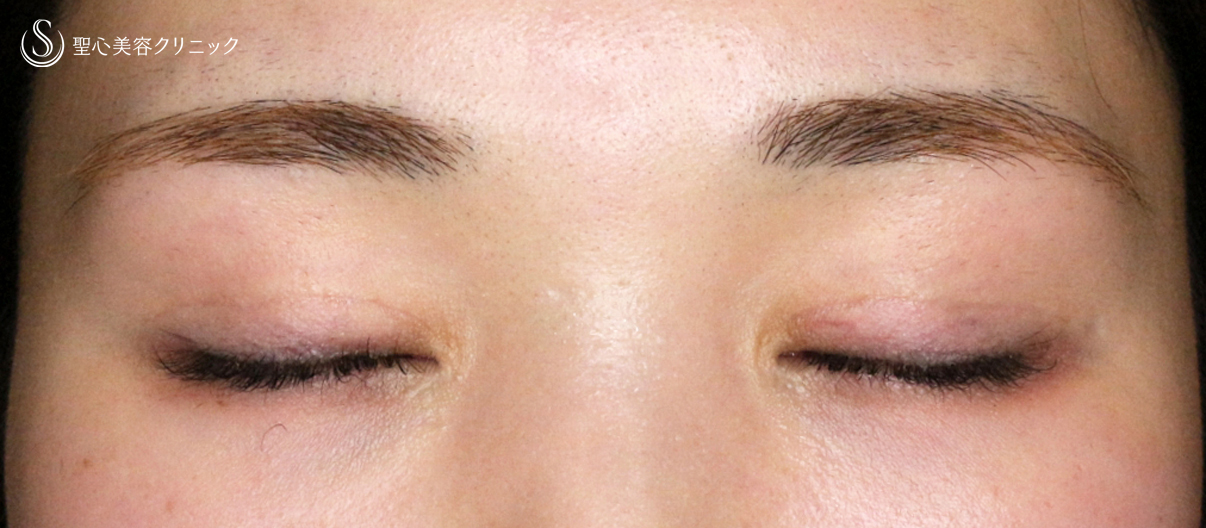 【20代女性・他院埋没法後を全切開で修正】二重全切開+α法 Ver.5.5（直後〜3ヶ月後） After 