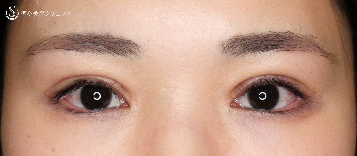 【20代女性・他院埋没法後を全切開で修正】二重全切開+α法 Ver.5.5（直後〜3ヶ月後） After 