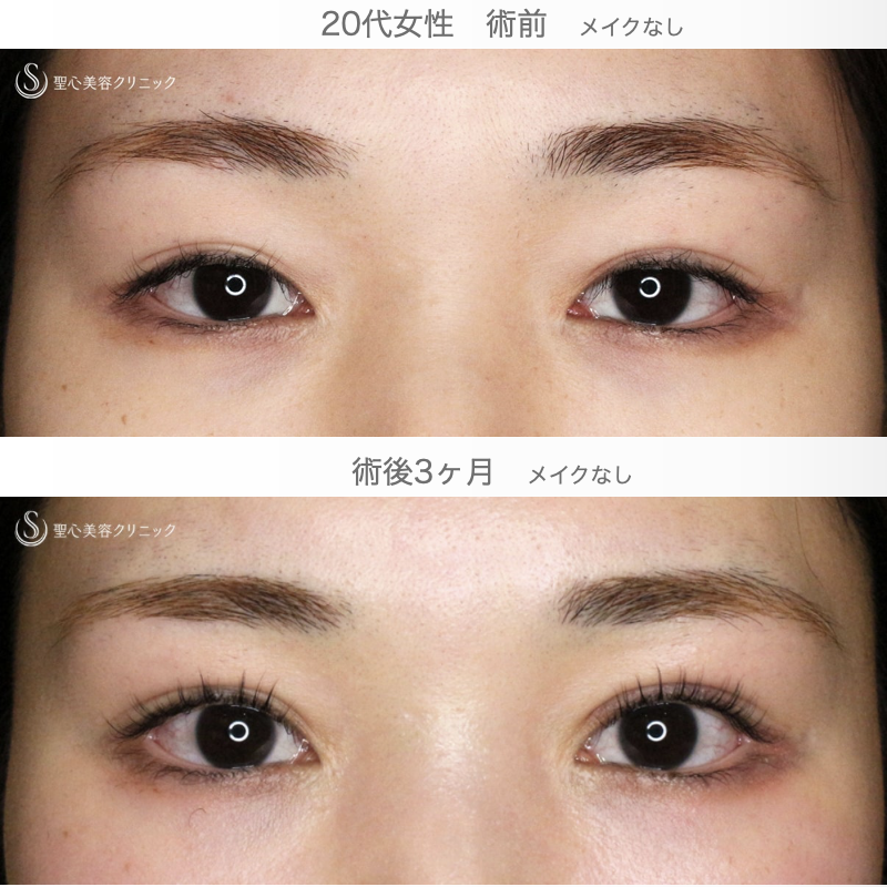 【20代女性・他院埋没法後を全切開で修正】二重全切開+α法 Ver.5.5（直後〜3ヶ月後） After 