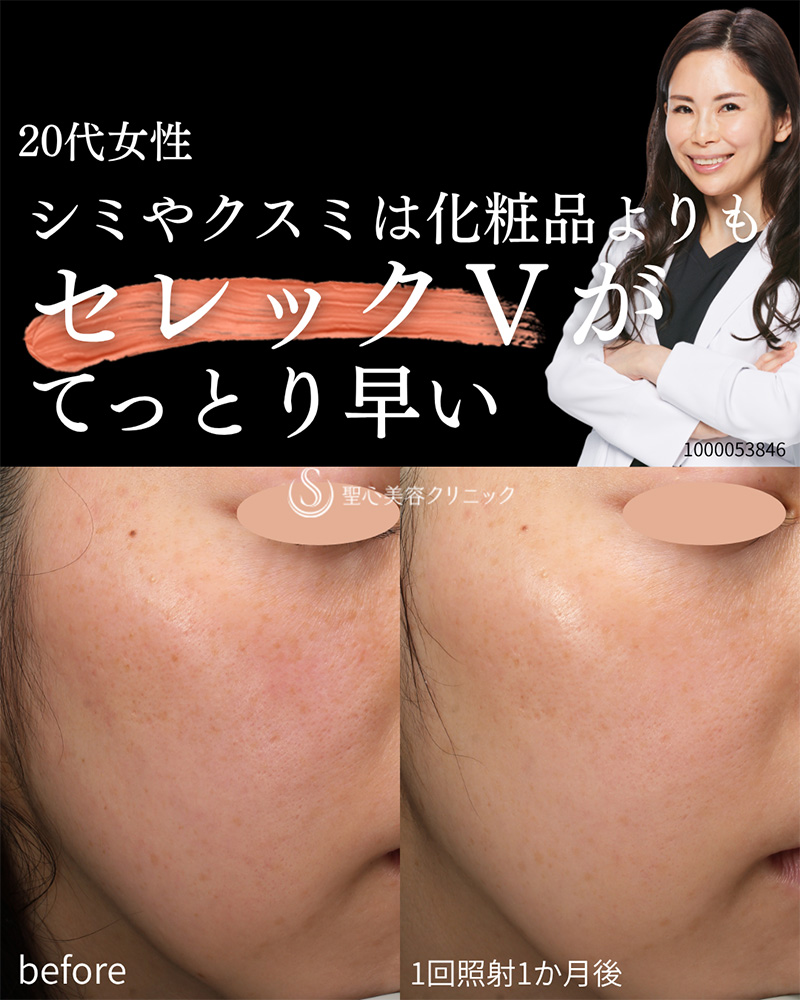【20代女性・シミくすみ】CellecV（セレックV）（1ヶ月後） After 