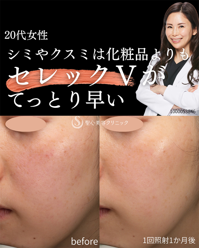 【20代女性・シミくすみ】CellecV（セレックV）（1ヶ月後） After 