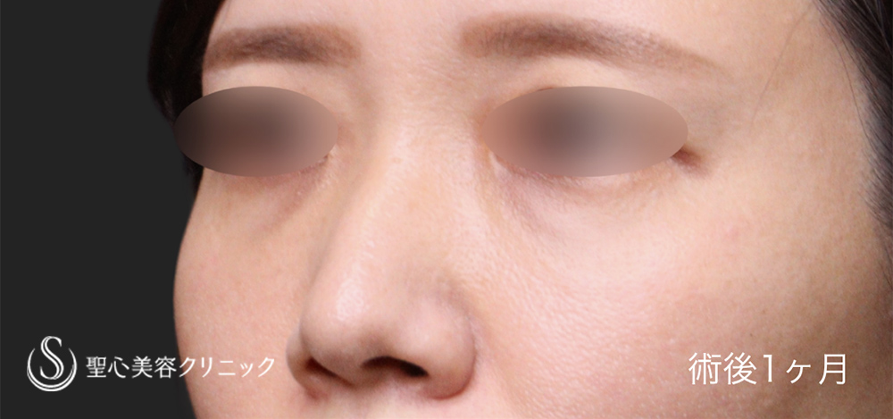 【40代女性・クマの改善】裏ハムラ法（1ヶ月後） After 