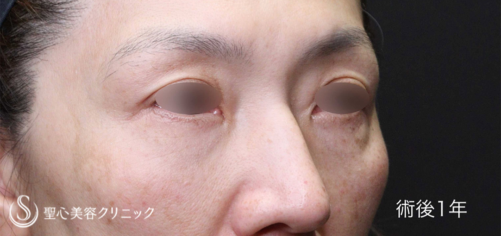 【50代女性・大きめのクマをしっかり改善】ハムラ法＋ミッドチークリフト（1年後）　 After 