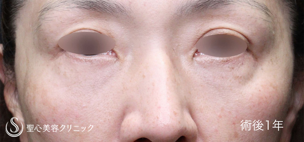【50代女性・大きめのクマをしっかり改善】ハムラ法＋ミッドチークリフト（1年後）　 After 