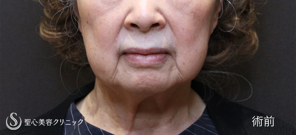 【70代女性・フェイスラインの華麗なる若返り】フェイスリフト（1ヶ月後）　 Before 