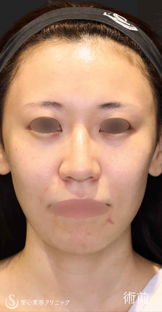 【30代女性・鼻中隔延長で自然な忘れ鼻に】 鼻中隔延長術＋鼻尖形成＋鷲鼻修正（1ヶ月後） Before 