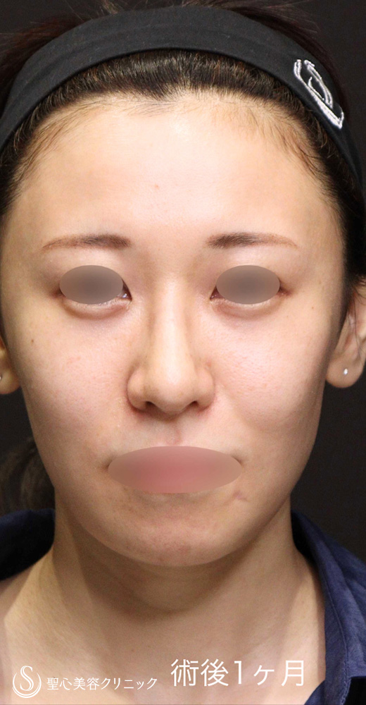 【30代女性・鼻中隔延長で自然な忘れ鼻に】 鼻中隔延長術＋鼻尖形成＋鷲鼻修正（1ヶ月後） After 