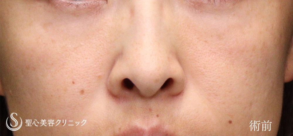 【30代女性・鼻の穴に丸みを】鼻孔縁下降術（術直後、術後2ヶ月） Before 