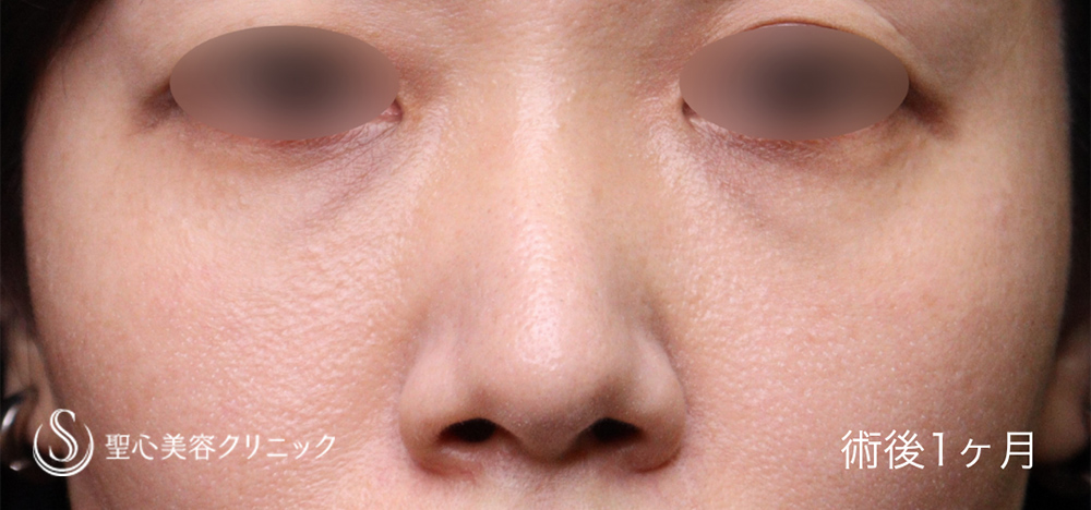【40代女性・クマの改善】裏ハムラ法（1ヶ月後） After 