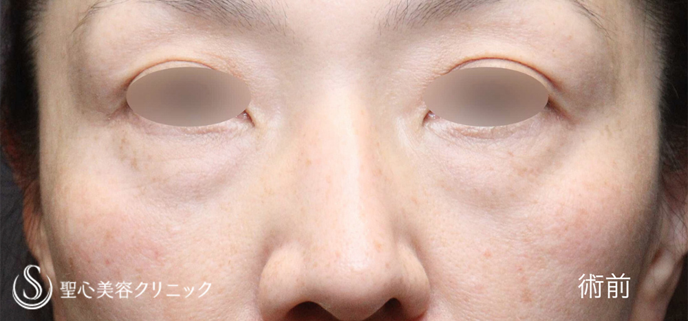 【50代女性・大きめのクマをしっかり改善】ハムラ法＋ミッドチークリフト（1年後）　 Before 