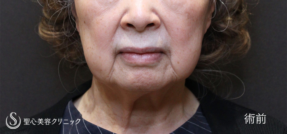 【70代女性・フェイスラインの華麗なる若返り】フェイスリフト（1ヶ月後）　 Before 