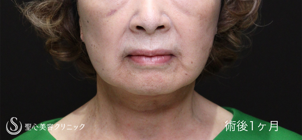 【70代女性・フェイスラインの華麗なる若返り】フェイスリフト（1ヶ月後）　 After 