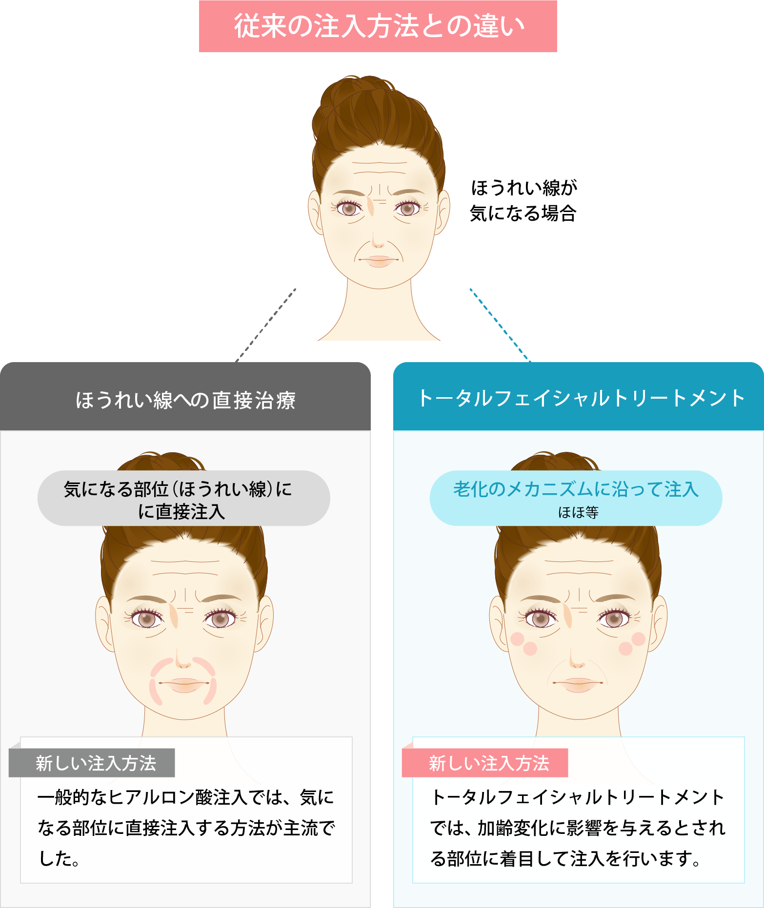 従来の注入方法との違い