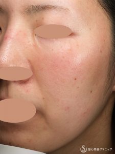 チップ　聖心夏季講習者 チップ様専用 聖心夏季講習者