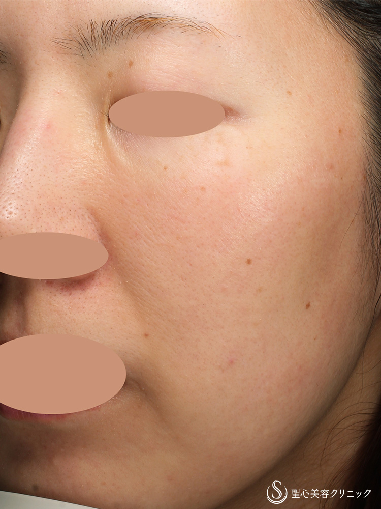 【20代女性・POTENZA S25チップ1回で赤みも毛穴も改善しなめらかな皮膚に】POTENZA（ポテンツァ）（3ヶ月後） After 