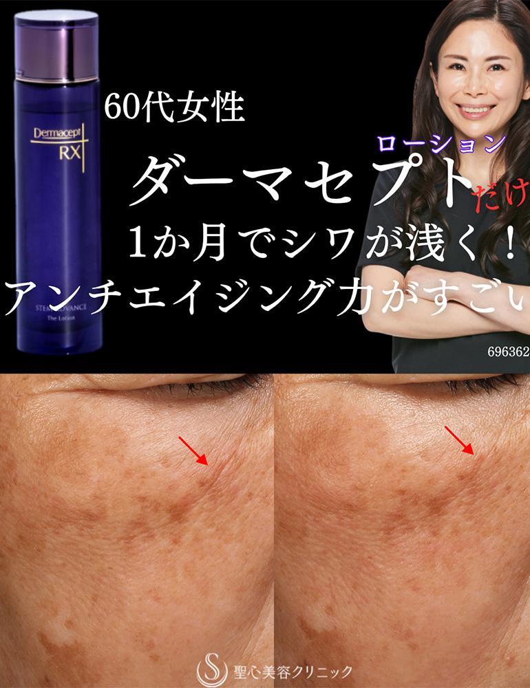 【60代女性・ダーマセプトローション1か月でシワが浅く】ダーマセプトRX ステムアドバンスシリーズ（1ヶ月後） After 