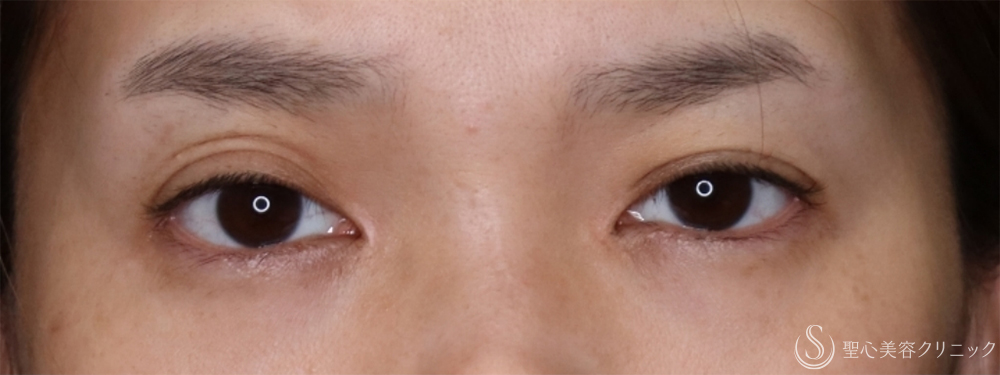 【40代女性・2回の目頭切開で理想のバランスの目に】目頭切開/目上切開（2ヶ月後） Before 