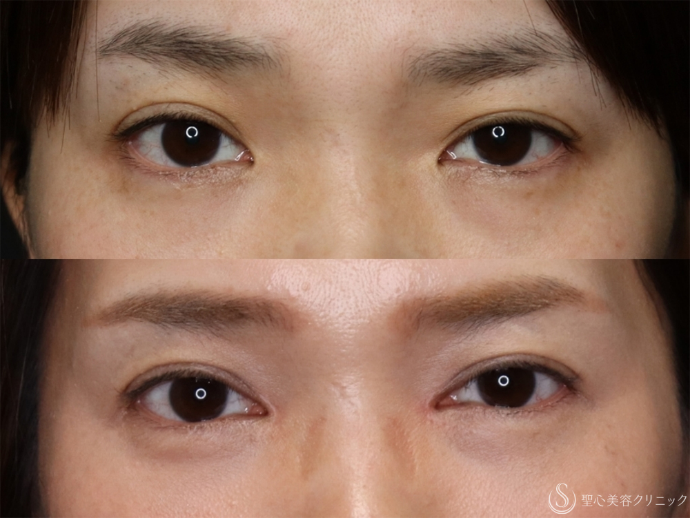 【40代女性・2回の目頭切開で理想のバランスの目に】目頭切開/目上切開（2ヶ月後） After 