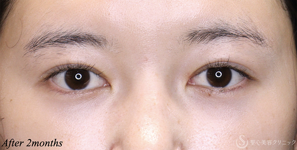 平行型二重 After