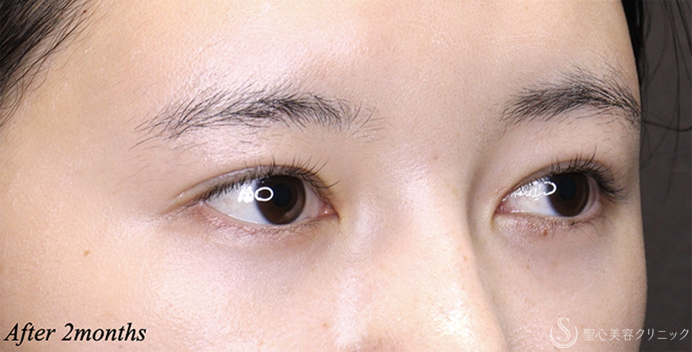 【20代女性・理想に近い平行型二重へ】 二重術（埋没法）：マイクロメソッド+α＋目上切開 術後2ヶ月 After 