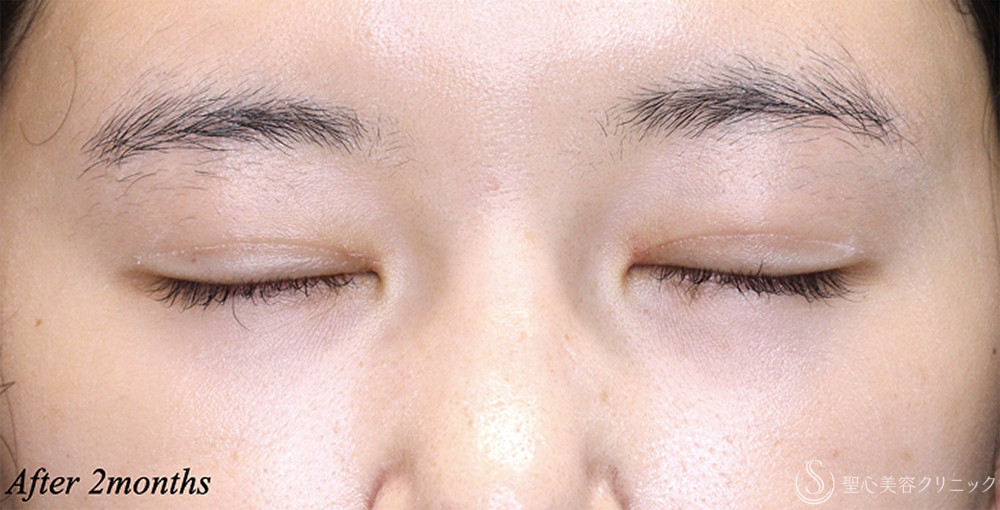 【20代女性・理想に近い平行型二重へ】 二重術（埋没法）：マイクロメソッド+α＋目上切開 術後2ヶ月 After 