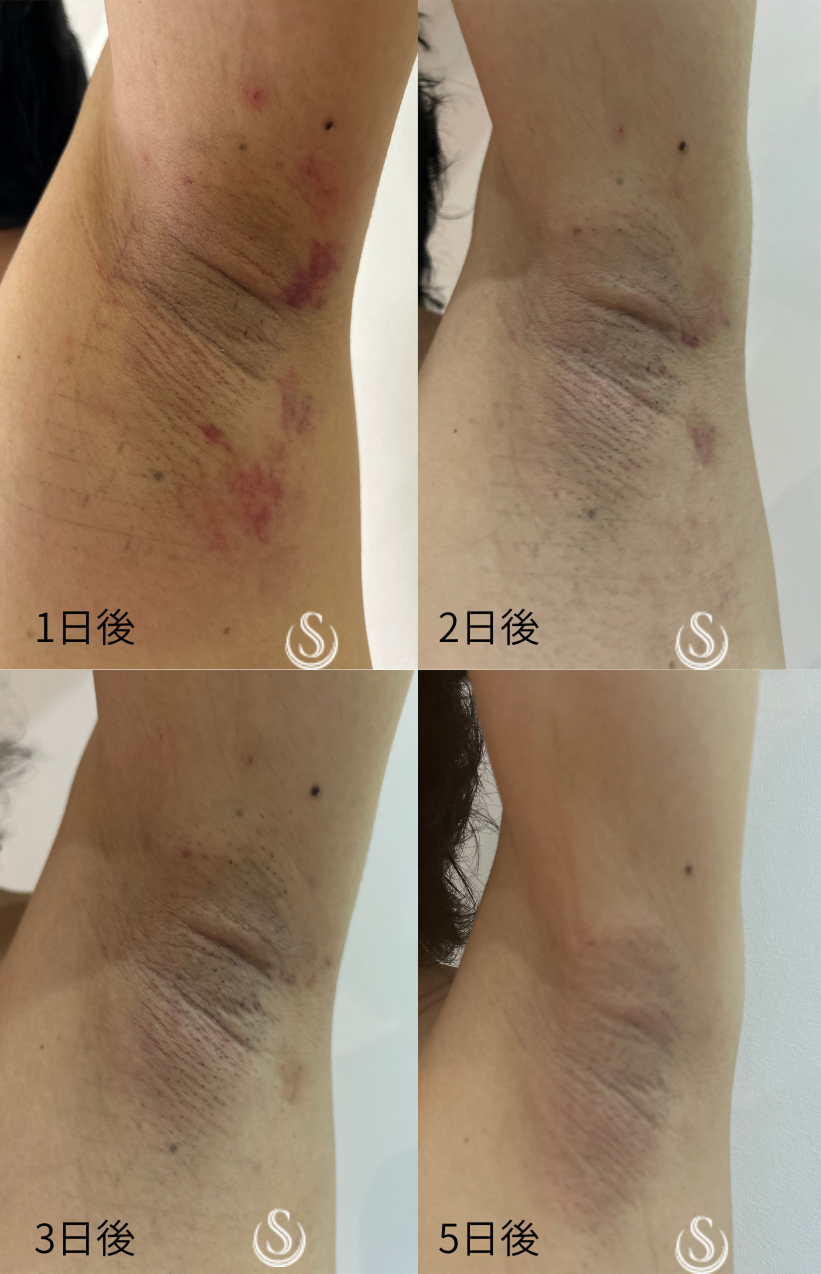 【40代男性・汗とにおいの治療】ミラドライ（2ヶ月後） After 
