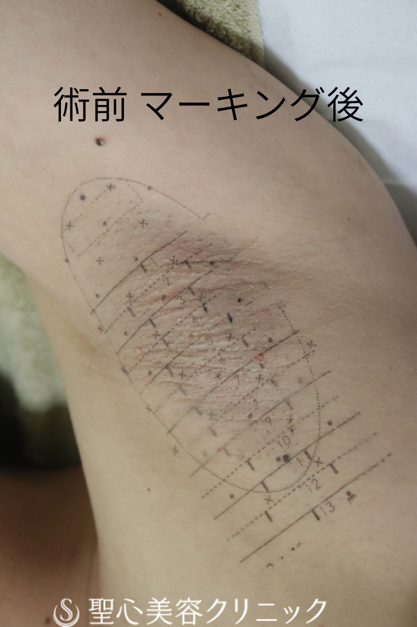 【40代男性・汗とにおいの治療】ミラドライ（2ヶ月後） Before 