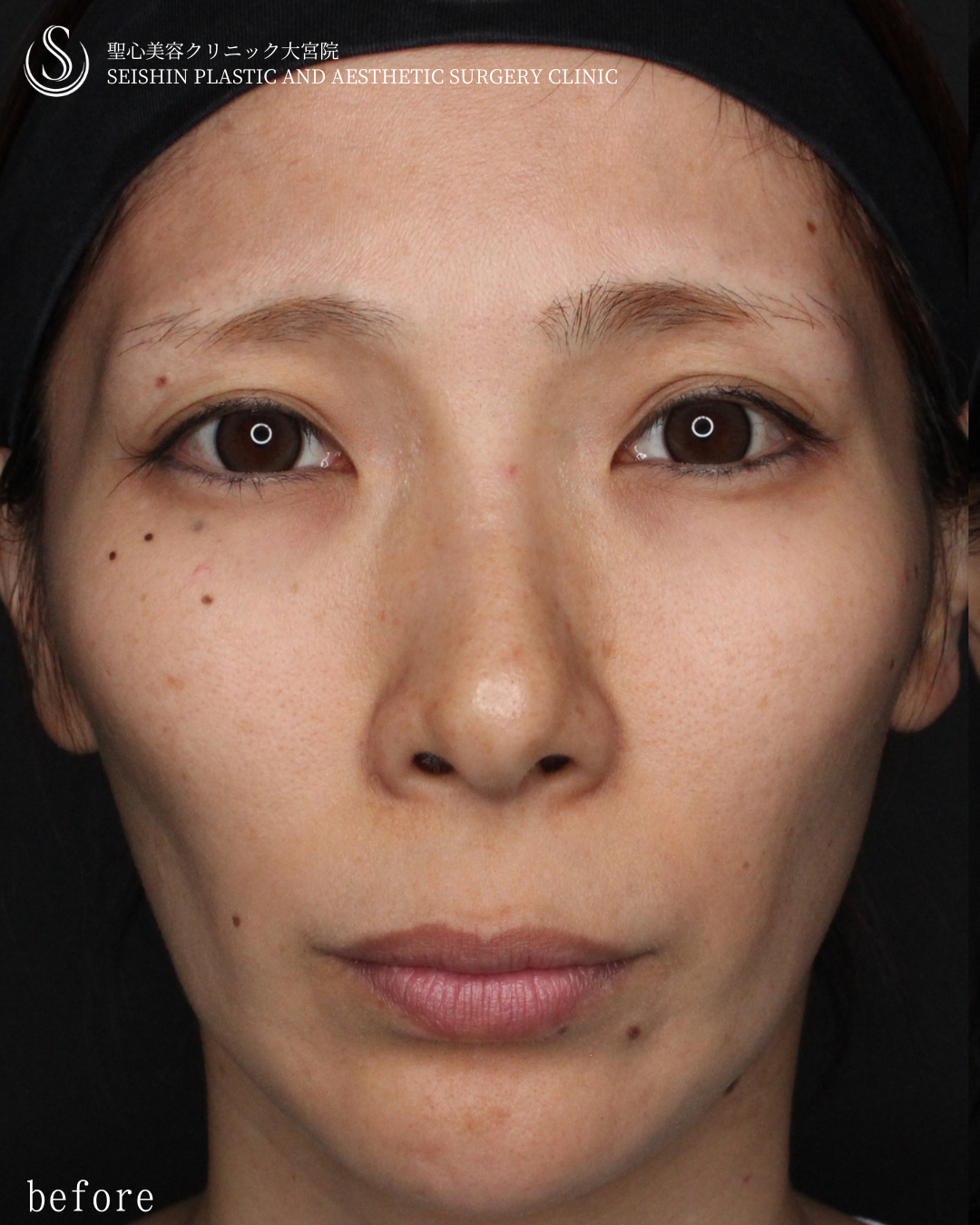 【30代女性・自然に若々しく】トータルフェイシャルトリートメント（1ヶ月後） Before 