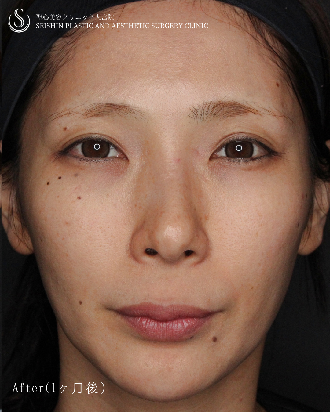 【30代女性・自然に若々しく】トータルフェイシャルトリートメント（1ヶ月後） After 