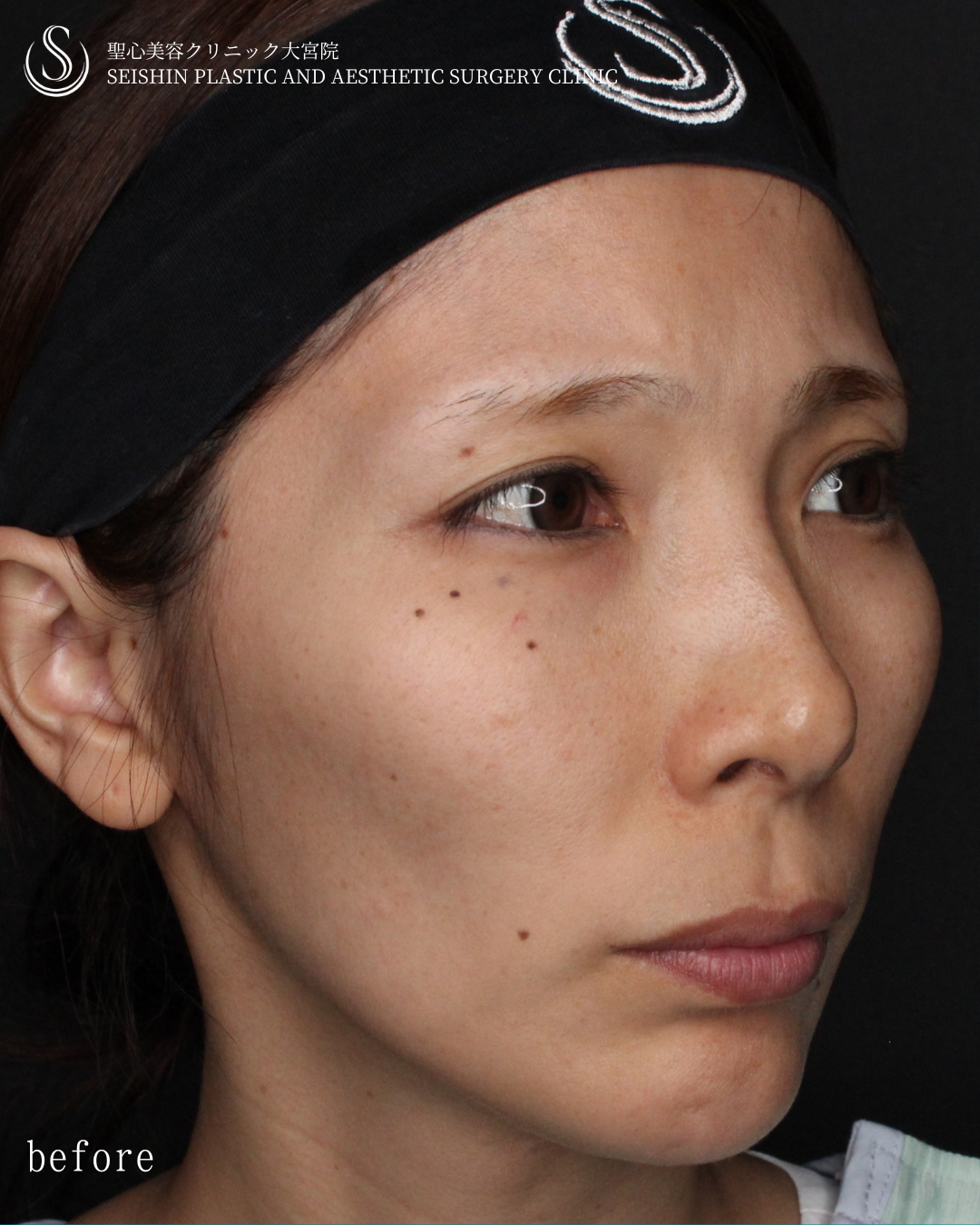 【30代女性・自然に若々しく】トータルフェイシャルトリートメント（1ヶ月後） Before 