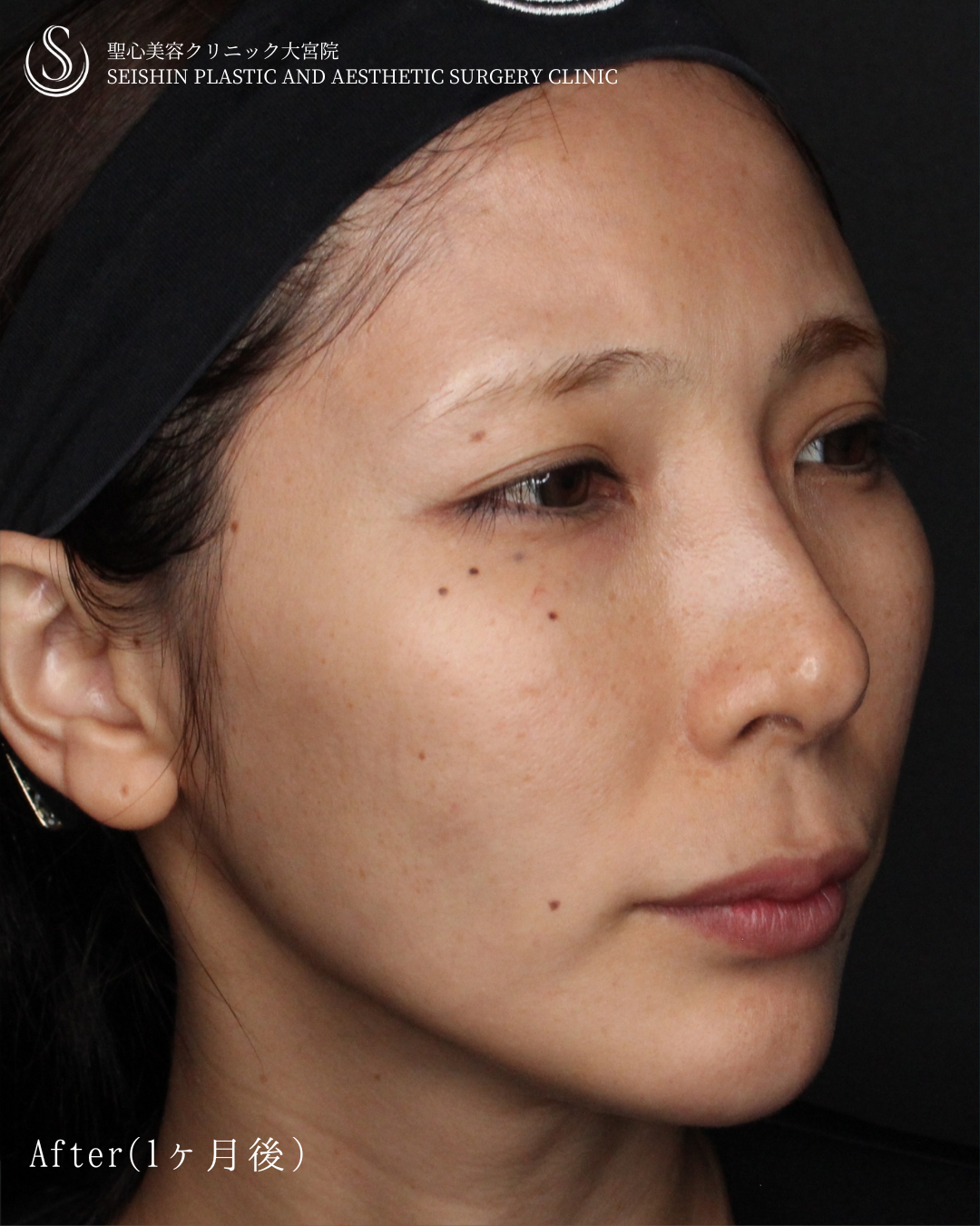 【30代女性・自然に若々しく】トータルフェイシャルトリートメント（1ヶ月後） After 