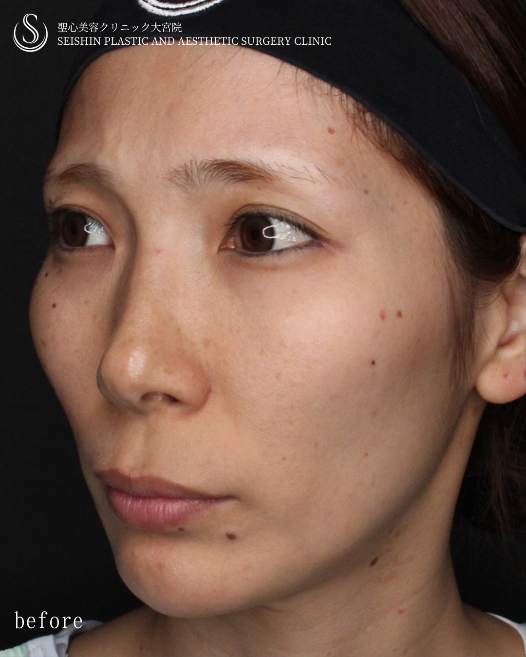 【30代女性・自然に若々しく】トータルフェイシャルトリートメント（1ヶ月後） Before 