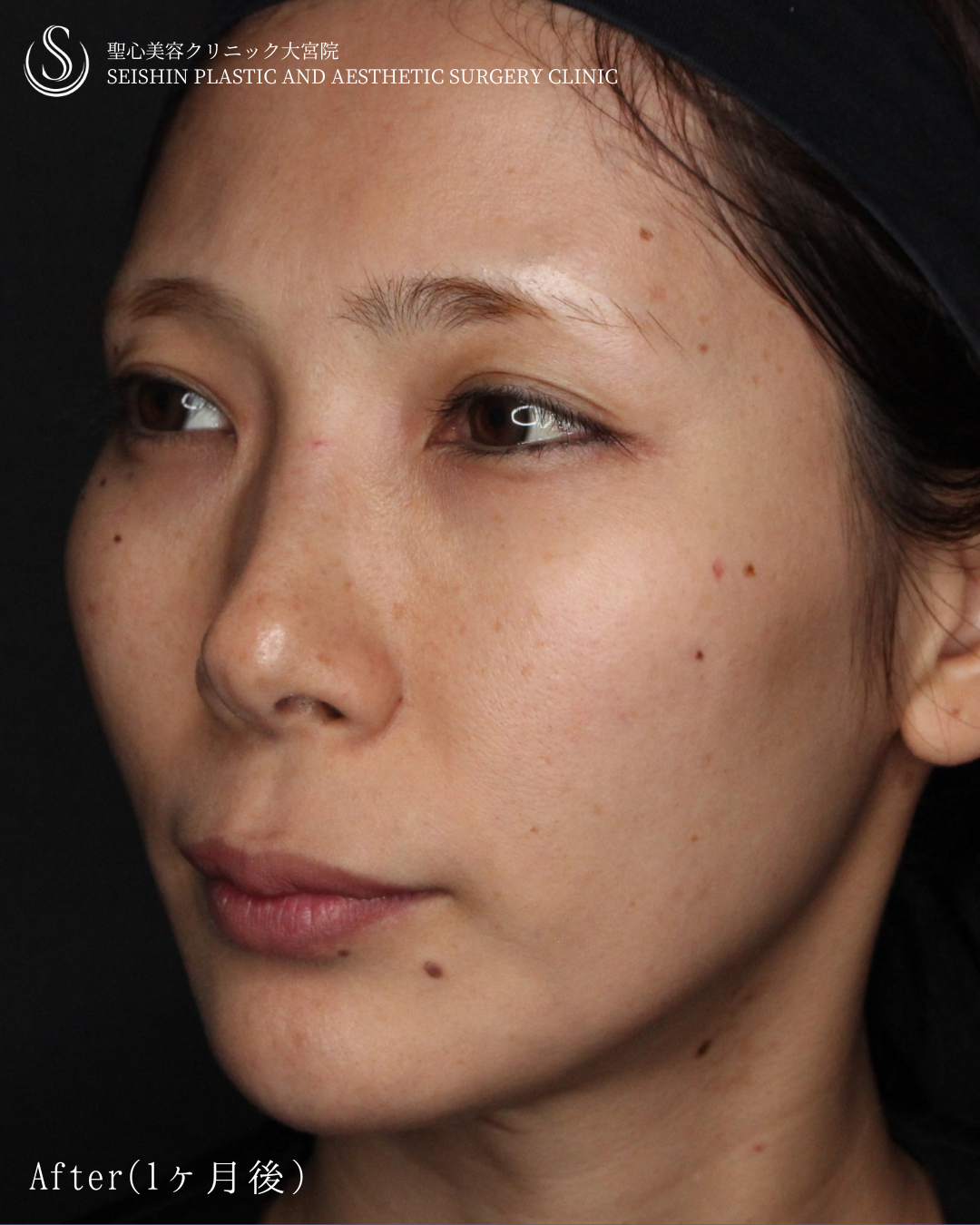 【30代女性・自然に若々しく】トータルフェイシャルトリートメント（1ヶ月後） After 