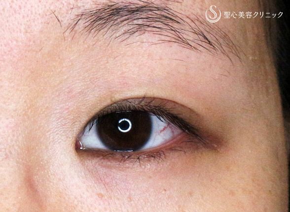 【30代女性・「つり目」を丸く優しい印象に】目尻切開＆グラマラスライン埋没法（1ヶ月後） Before 