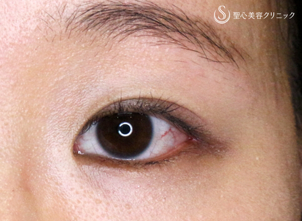 【30代女性・「つり目」を丸く優しい印象に】目尻切開＆グラマラスライン埋没法（1ヶ月後） After 