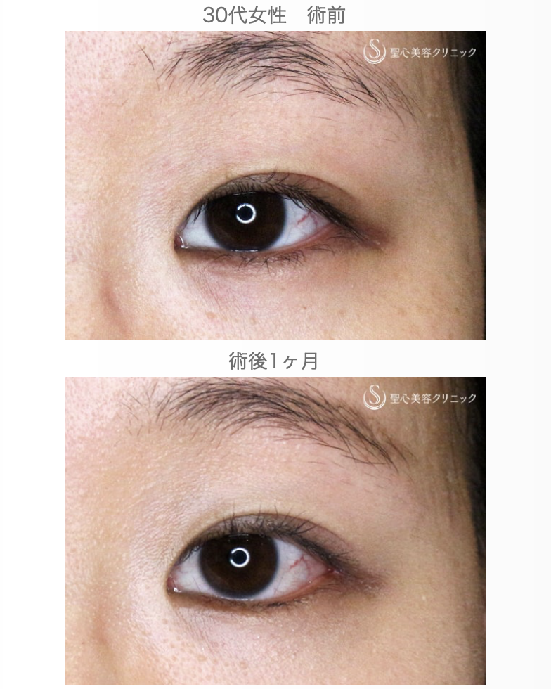 【30代女性・「つり目」を丸く優しい印象に】目尻切開＆グラマラスライン埋没法（1ヶ月後） After 